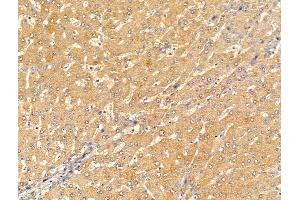 ABIN7094620 and ABIN7098670 at 1/100 staining Human liver cancer and adjacent normal tissues by IHC-P. (CRAT antibody  (Internal Region))