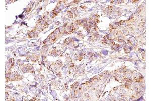ABIN6274832 at 1/100 staining Human breast cancer tissue by IHC-P.