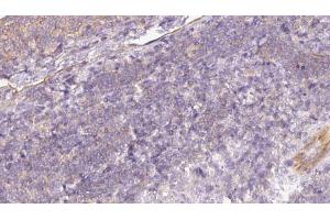ABIN6273057 at 1/100 staining Human lymph cancer tissue by IHC-P. (MTHFD2 antibody  (N-Term))