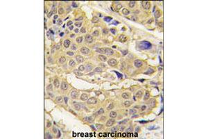 Formalin-fixed and paraffin-embedded human breast carcinoma tissue reacted with EPRS polyclonal antibody  , which was peroxidase-conjugated to the secondary antibody, followed by DAB staining. (EPRS antibody  (N-Term))