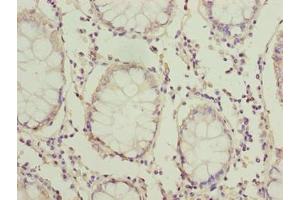 Immunohistochemistry of paraffin-embedded human colon cancer using ABIN7165635 at dilution of 1:100 (HOOK1 antibody  (AA 301-600))