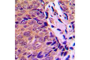 Immunohistochemical analysis of Ah Receptor (pS36) staining in human breast cancer formalin fixed paraffin embedded tissue section. (Aryl Hydrocarbon Receptor antibody  (N-Term, pSer36))