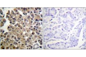 Immunohistochemistry analysis of paraffin-embedded human breast carcinoma tissue, using PDGFRB (Ab-1009) Antibody. (PDGFRB antibody  (AA 981-1030))