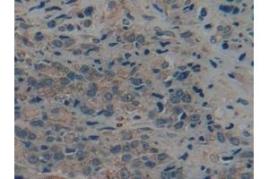 Detection of CK9 in Human Prostate cancer Tissue using Polyclonal Antibody to Cytokeratin 9 (CK9) (KRT9 antibody  (AA 315-456))