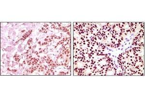 Immunohistochemical analysis of paraffin-embedded human breast carcinoma, using ER-alpha mouse mAb showing nuclear expression with DAB staining. (Estrogen Receptor alpha antibody  (AA 410-592))