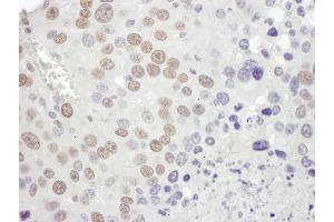 Immunohistochemistry (IHC) image for anti-Mismatch Repair Protein 2 (MSH2) (C-Term) antibody (ABIN7453440) (MSH2 antibody  (C-Term))