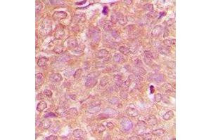 Immunohistochemical analysis of NBEAL1 staining in human breast cancer formalin fixed paraffin embedded tissue section. (NBEAL1 antibody)