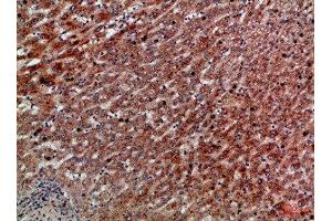 Immunohistochemical analysis of paraffin-embedded Human-liver-cancer, antibody was diluted at 1:100 (CXCR1 antibody  (AA 1-50))