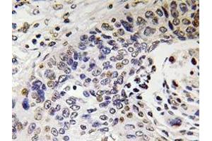 Immunohistochemistry analyzes of NF-H antibody in paraffin-embedded human lung carcinoma tissue. (NEFH antibody)