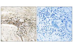 Immunohistochemistry analysis of paraffin-embedded human lung carcinoma tissue using SSH3 antibody. (SSH3 antibody  (Internal Region))