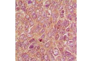 Immunohistochemical analysis of DUSP9 staining in human breast cancer formalin fixed paraffin embedded tissue section. (DUSP9 antibody)