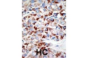 Formalin-fixed and paraffin-embedded human cancer tissue reacted with the primary antibody, which was peroxidase-conjugated to the secondary antibody, followed by DAB staining. (UBA3 antibody  (C-Term))