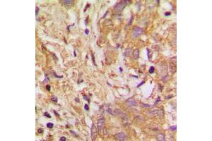 Immunohistochemical analysis of VEGFB staining in human breast cancer formalin fixed paraffin embedded tissue section. (VEGFB antibody  (Center))
