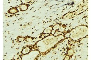 ABIN6274369 at 1/100 staining Human breast cancer tissue by IHC-P. (Translin antibody  (Internal Region))