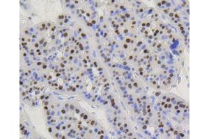 Paraformaldehyde-fixed, paraffin embedded Human liver carcinoma, Antigen retrieval by boiling in sodium citrate buffer (pH6) for 15min, Block endogenous peroxidase by 3% hydrogen peroxide for 30 minutes, Blocking buffer at 37°C for 20min, Antibody incubation with Cyclin D1 (2H4) Monoclonal Antibody  at 1:50 overnight at 4°C, followed by a conjugated secondary and DAB staining. (Cyclin D1 antibody)