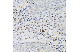 Immunohistochemistry of paraffin-embedded human lung cancer using GEMIN2 Antibody (ABIN1872798) at dilution of 1:100 (40x lens). (SIP1 antibody)