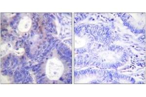 Immunohistochemistry analysis of paraffin-embedded human colon carcinoma, using TEBP (Phospho-Ser113) Antibody. (NKX2-1 antibody  (pSer113))