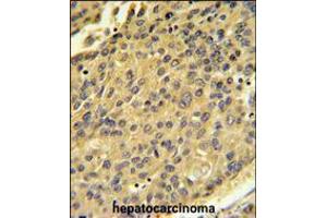 CTSH Antibody IHC analysis in formalin fixed and paraffin embedded human hepatocarcinoma followed by peroxidase conjugation of the secondary antibody and DAB staining.