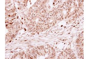 IHC-P Image SKAP55 antibody detects SKAP1 protein at cytoplasm on human colon carcinoma by immunohistochemical analysis. (SKAP1 antibody)