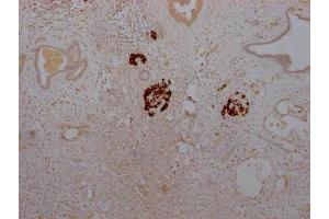 IHC image of ABIN7127574 diluted at 1:100 and staining in paraffin-embedded human pancreatic cancer performed on a Leica BondTM system. (Recombinant Insulin antibody)