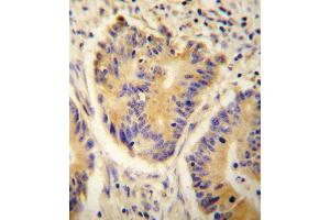 ADH4 antibody immunohistochemistry analysis in formalin fixed and paraffin embedded human colon carcinoma followed by peroxidase conjugation of the secondary antibody and DAB staining.