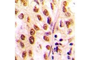 Immunohistochemical analysis of Histone Deacetylase 2 staining in human lung cancer formalin fixed paraffin embedded tissue section. (HDAC2 antibody  (C-Term))