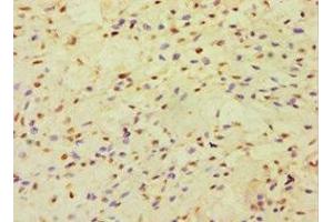 Immunohistochemistry of paraffin-embedded human breast cancer using ABIN7150999 at dilution of 1:100 (CBLC antibody  (AA 245-474))