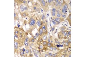 Immunohistochemistry of paraffin-embedded human esophageal cancer using PPP1CB antibody (ABIN6290762) at dilution of 1:100 (40x lens).