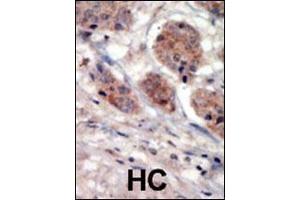 Formalin-fixed and paraffin-embedded human cancer tissue reacted with the primary antibody, which was peroxidase-conjugated to the secondary antibody, followed by DAB staining. (PI4K2A antibody  (N-Term))