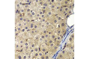 Immunohistochemistry of paraffin-embedded human liver cancer using AP2A2 antibody (ABIN6292468) at dilution of 1:200 (40x lens). (AP2A2 antibody)
