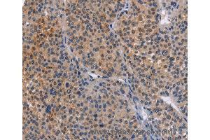Immunohistochemistry of Human cervical cancer using MAP3K13 Polyclonal Antibody at dilution of 1:40 (MAP3K13 antibody)
