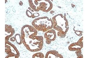Formalin-fixed, paraffin-embedded human colon carcinoma stained with Cytokeratin 18 antibody (DE-K18).