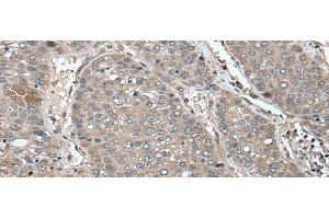 Immunohistochemistry of paraffin-embedded Human liver cancer tissue using UNC45B Polyclonal Antibody at dilution of 1:65(x200) (UNC45B antibody)