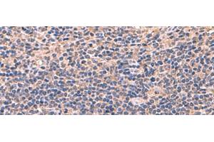 Immunohistochemistry of paraffin-embedded Human cervical cancer tissue using AHCYL1 Polyclonal Antibody at dilution of 1:70(x200) (AHCYL1 antibody)