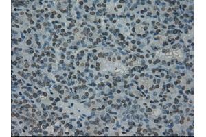 Immunohistochemical staining of paraffin-embedded Carcinoma of thyroid tissue using anti-PRKYmouse monoclonal antibody. (PRKY antibody)
