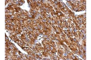 IHC-P Image Immunohistochemical analysis of paraffin-embedded U87 xenograft, using BIN1, antibody at 1:500 dilution. (BIN1 antibody)