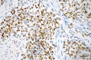 Immunohistochemistry was performed on paraffin-embedded human breast carcinoma using RBBP4 antibody (ABIN7800185), 1:200). (Recombinant Retinoblastoma Binding Protein 4 antibody)