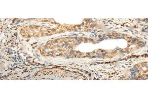 Immunohistochemistry of paraffin-embedded Human cervical cancer tissue using ZNF8 Polyclonal Antibody at dilution of 1:40(x200) (ZNF8 antibody)