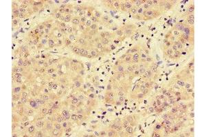 Immunohistochemistry of paraffin-embedded human liver cancer using ABIN7159112 at dilution of 1:100 (MED17 antibody  (AA 411-651))