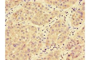 Immunohistochemistry of paraffin-embedded human liver cancer using ABIN7159112 at dilution of 1:100