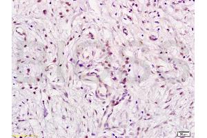 Formalin-fixed and paraffin embedded human gastric carcinoma labeled with Anti E2F5 Polyclonal Antibody, Unconjugated (ABIN733673) at 1:200 followed by conjugation to the secondary antibody and DAB staining (E2F5 antibody  (AA 101-200))