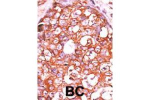 Formalin-fixed and paraffin-embedded human breast cancer tissue reacted with DUSP14 polyclonal antibody  , which was peroxidase-conjugated to the secondary antibody, followed by AEC staining. (DUSP14 antibody  (AA 1-30))