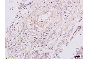 Formalin-fixed and paraffin embedded human esophageal carcinoma labeled with Anti PGRN/Granulin Polyclonal Antibody,Unconjugated (ABIN728668) at 1:200 followed by conjugation to the secondary antibody and DAB staining. (Granulin antibody  (AA 451-550))