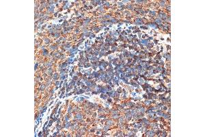 Immunohistochemistry of paraffin-embedded human esophageal cancer using FIP200 Rabbit pAb (ABIN7269881) at dilution of 1:100 (40x lens). (FIP200 antibody  (C-Term))