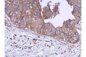 IHC-P Image Immunohistochemical analysis of paraffin-embedded human breast cancer, using UKHC, antibody at 1:500 dilution. (KIF5B antibody  (C-Term))
