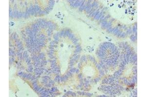Immunohistochemistry of paraffin-embedded human colon cancer using ABIN7156833 at dilution of 1:100 (IL18RAP antibody  (AA 390-599))