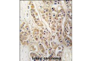 Formalin-fixed and paraffin-embedded human breast carcinoma tissue reacted with CLIC4 antibody , which was peroxidase-conjugated to the secondary antibody, followed by DAB staining. (CLIC4 antibody)