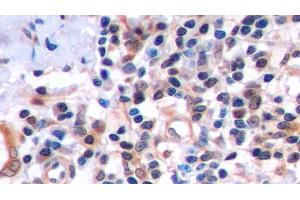 Detection of FAS in Human Endometrial cancer Tissue using Polyclonal Antibody to Factor Related Apoptosis (FAS) (FAS antibody  (AA 22-172))