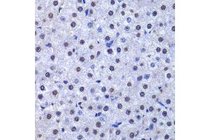 Immunohistochemistry of paraffin-embedded human liver cancer using GSTP1 antibody. (GSTP1 antibody  (AA 1-210))
