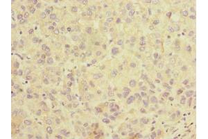 Immunohistochemistry of paraffin-embedded human liver cancer using ABIN7170191 at dilution of 1:100 (SLC25A36 antibody  (AA 58-110))